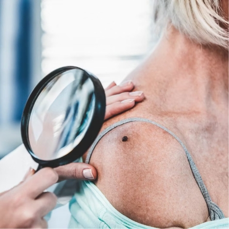 Skin Cancer Screenings