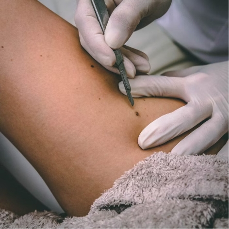 Skin Cancer Treatments